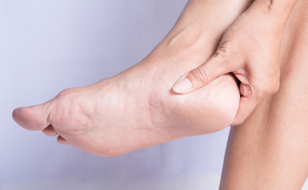 Cuáles son los síntomas de un espolón en el pie o espolón calcáneo