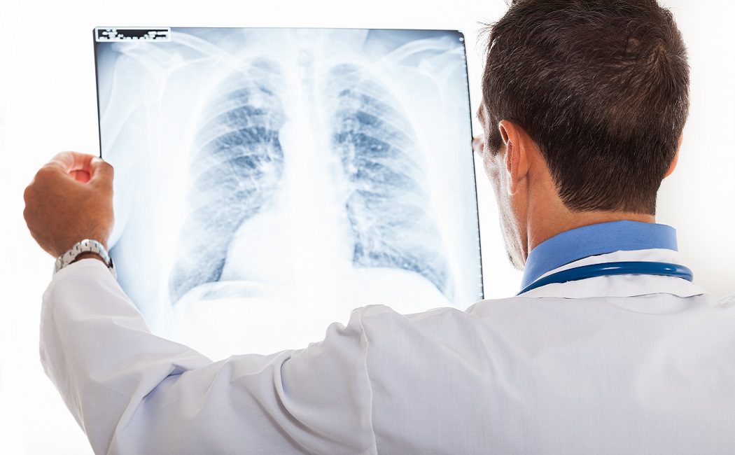 Cómo prevenir el cáncer de pulmón