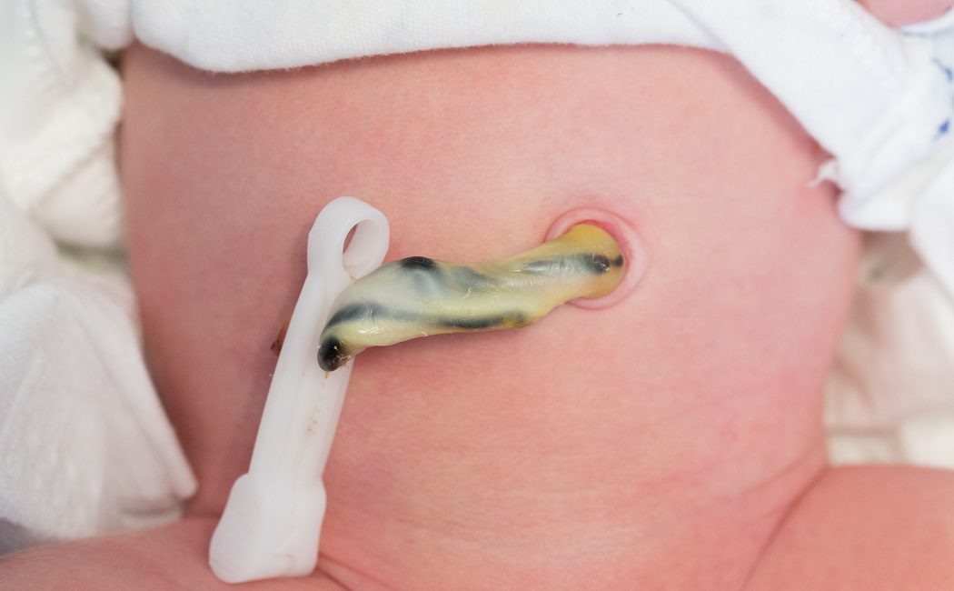El cordón umbilical del recién nacido