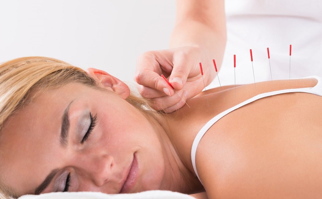 9 cosas que no sabes sobre acupuntura