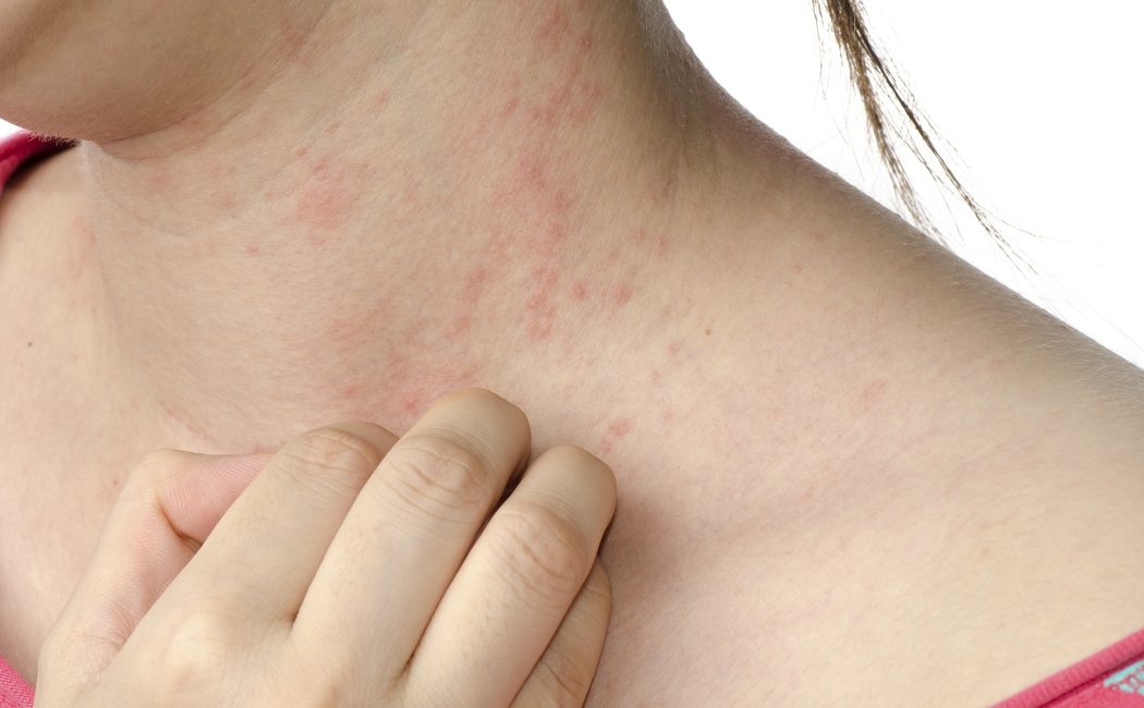 Qué es la dermatitis herpetiforme