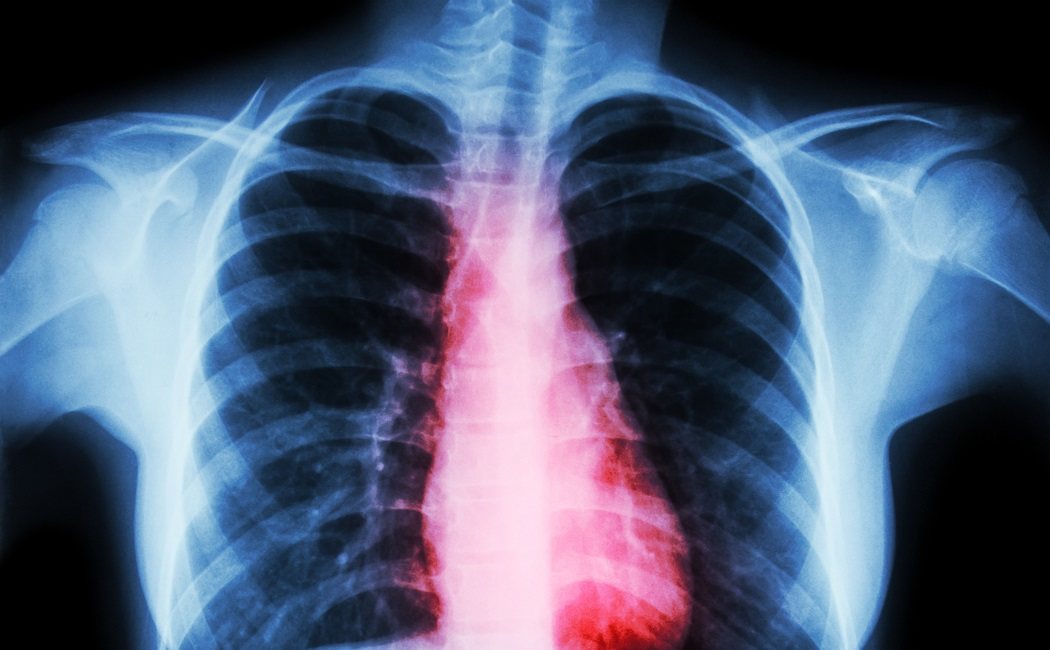 Qué es el infarto pulmonar