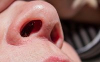 Costras en la nariz: remedios caseros
