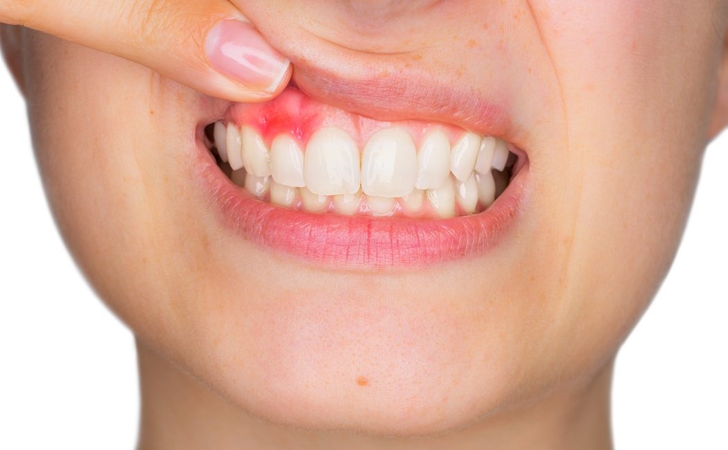 En qué consiste el absceso dental