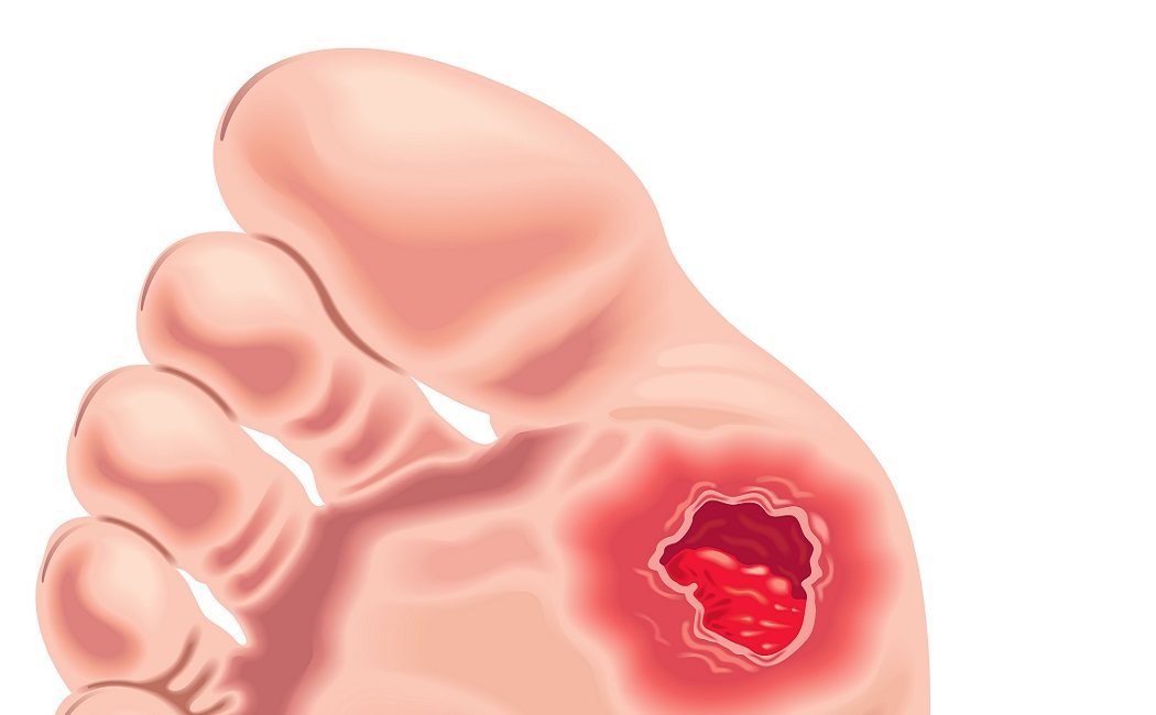 Las úlceras vasculares: qué son, a qué se deben y cómo podemos prevenirlas