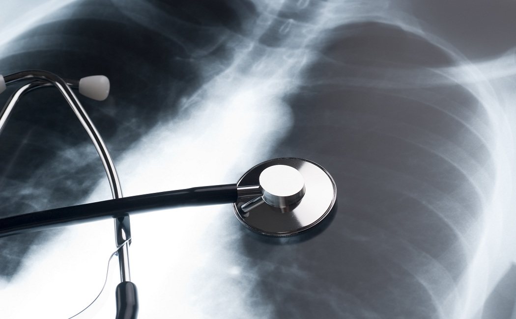 Trastornos pulmonares: atelectasia