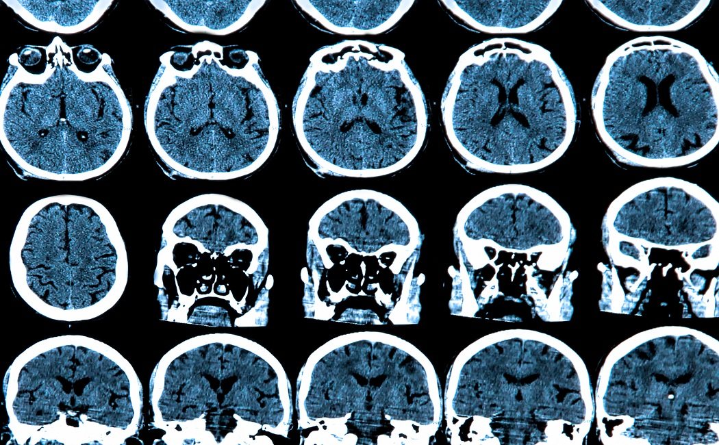 Síntomas de un tumor en el cerebelo