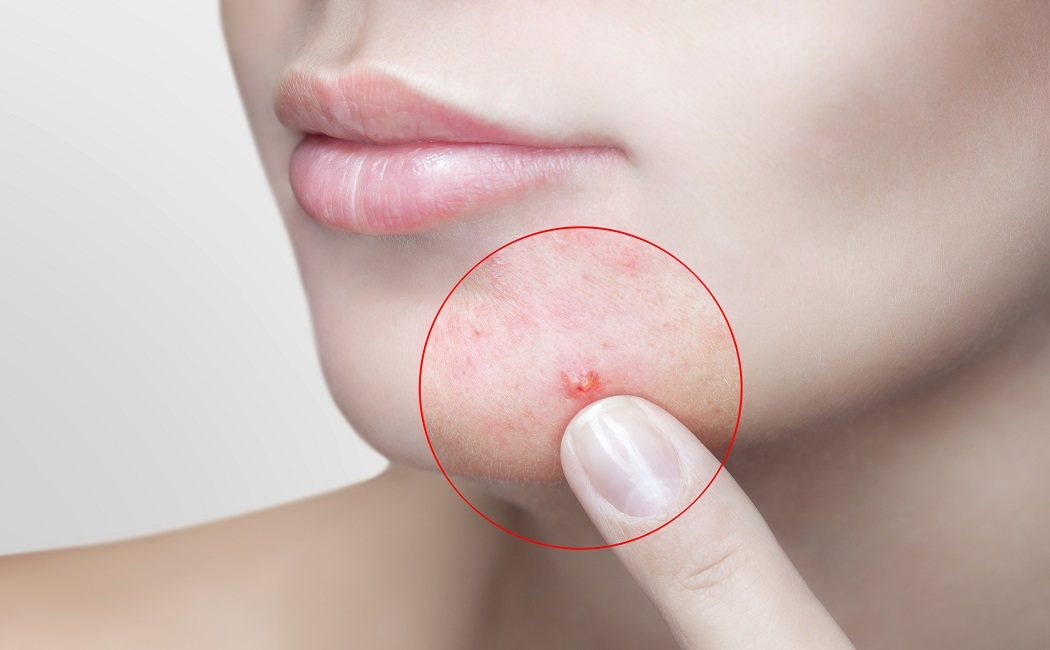 Qué es el acné hormonal