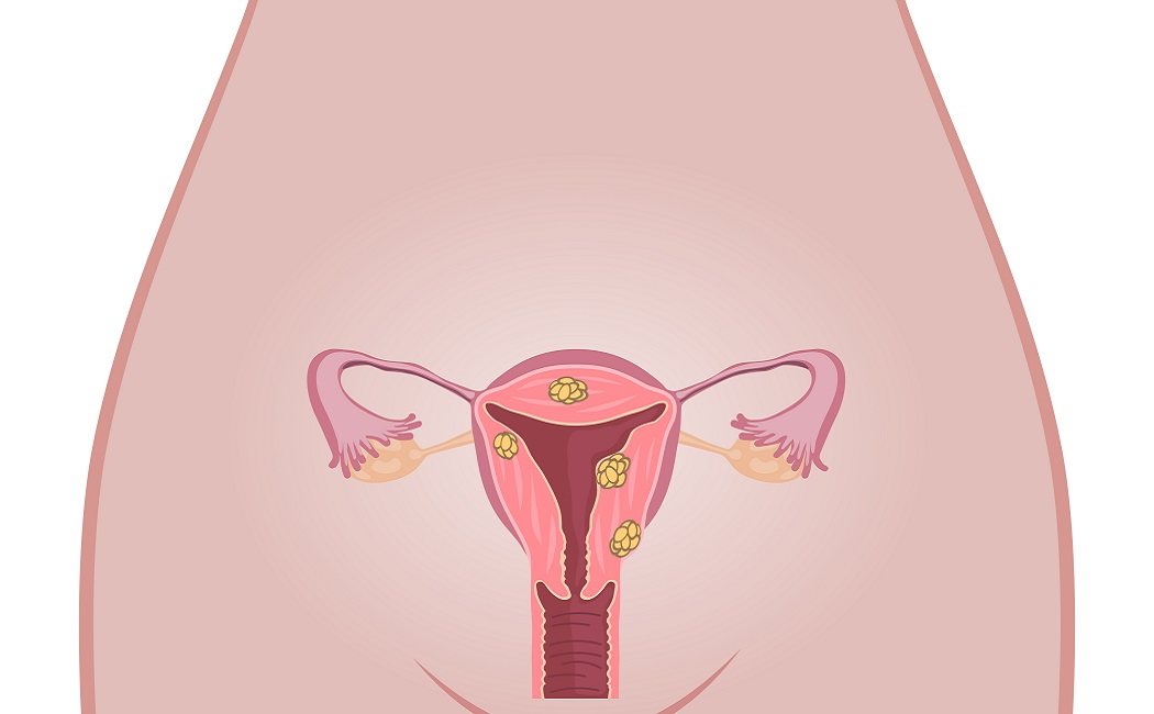 Cáncer vulvar