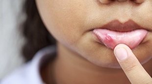 Las 3 causas principales por las que se produce el herpes labial