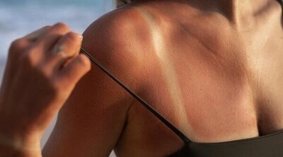 Qué hacer si te has quemado la piel con el sol