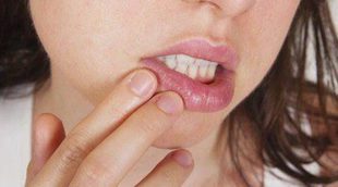 Herpes labial: Todo lo que debes saber