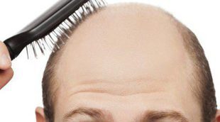 Minoxidil contra la alopecia, ¿es efectivo?