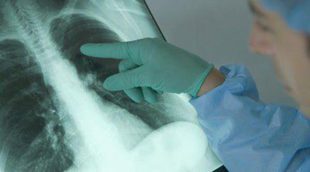 Cáncer de pulmón: síntomas y diagnóstico