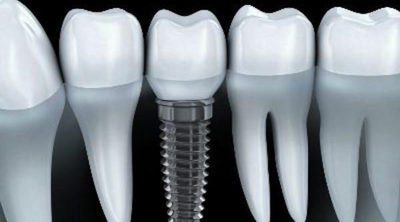 ¿Cuándo es necesario recurrir a los implantes dentales?