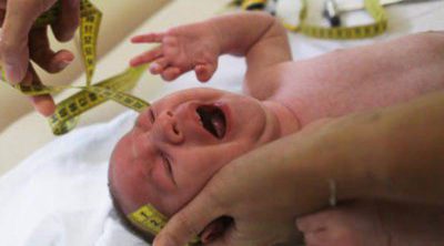 Qué es la microcefalia, la alteración causada por el Zika en bebés
