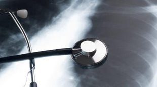 Causas y síntomas de la fibrosis pulmonar