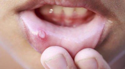 Aftas, llagas y úlceras bucales: remedios naturales para curarlas