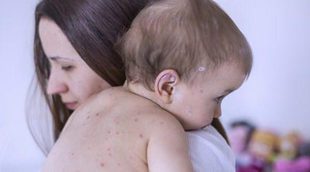 La varicela en bebés