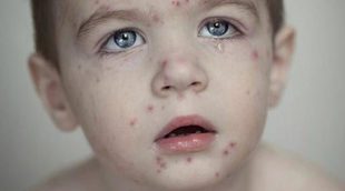 La varicela en niños: todo lo que debes saber