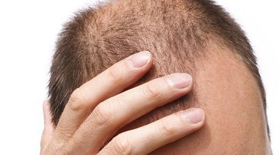 ¿Se puede prevenir la alopecia?