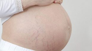 Cómo evitar que salgan las estrías durante el embarazo