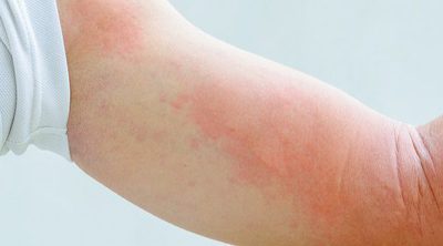 Cuáles son las enfermedades más habituales de la piel