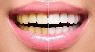 Hábitos saludables que destruyen tus dientes poco a poco