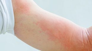 En qué consiste la dermatitis atópica