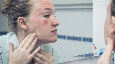 Qué es el vitiligo y por qué sucede