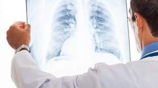 Qué causa cáncer de pulmón en los no fumadores