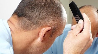 Qué es la alopecia androgenética