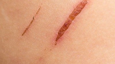 Qué son los queloides en la piel