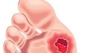 Las úlceras vasculares: qué son, a qué se deben y cómo podemos prevenirlas