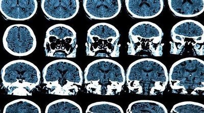 Síntomas de un tumor en el cerebelo