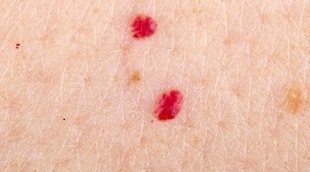 Qué son los puntos rojos que salen en la piel