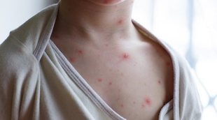 Primeros síntomas del sarampión en niños pequeños