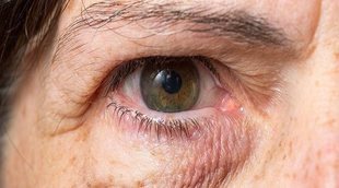Carnosidad en los ojos: causas y tratamiento